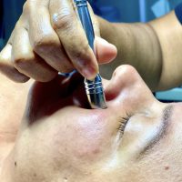 microdermabrasion-1